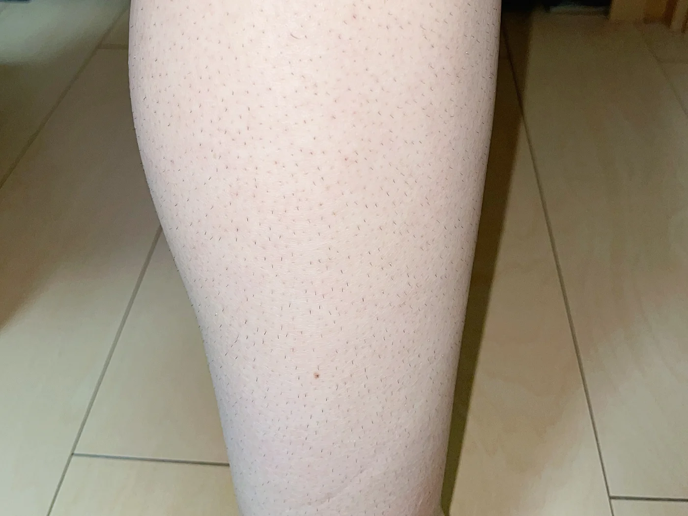 2週間経過後の足の様子